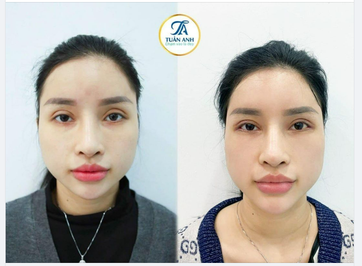 Có thể chị em nhìn thoáng qua thì sẽ khó nhận biết nhưng mí trên của khách hàng đã cắt nhiều lần và bị tình trạng: