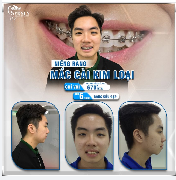Niềng răng kim loại hiệu quả như thế nào?