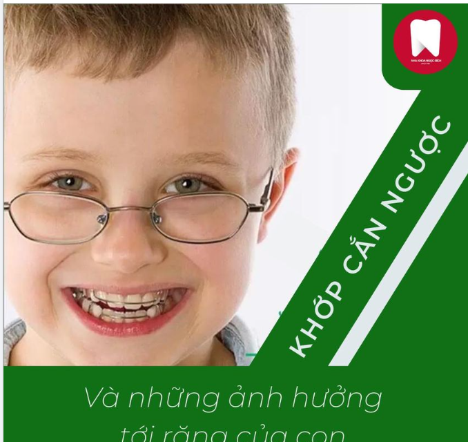 KHỚP CẮN NGƯỢC - NHỮNG ẢNH HƯỞNG KHÔNG TƯỞNG ĐẾN RĂNG CỦA CON