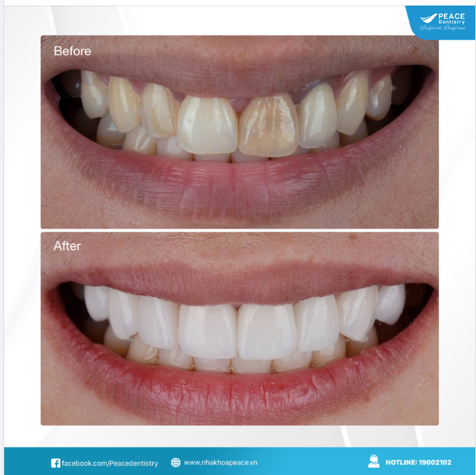 Khắc phục răng sậm màu hiệu quả bằng phương pháp thẩm mỹ răng sứ