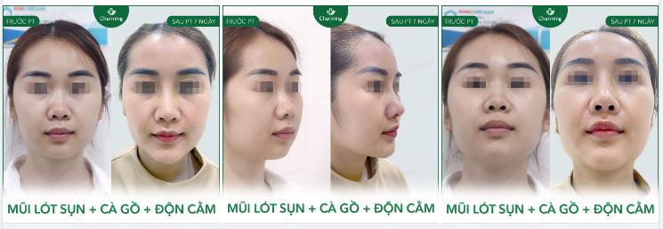 Gồ mũi là khi tình trạng xương mũi phát triển quá mức, tạo thành gồ trên sống mũi.