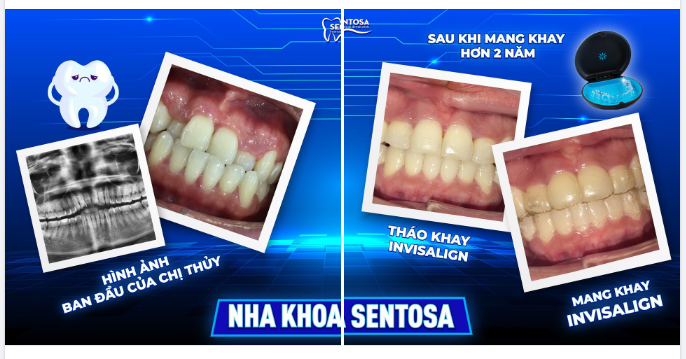 CHỈNH NHA INVISALIGN LUÔN LÀ LỰA CHỌN ƯU TIÊN CỦA KHÁCH HÀNG KHI ĐẾN SENTOSA