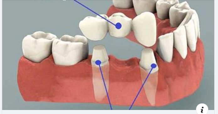 Làm cầu răng sứ có gây hôi miệng không ?