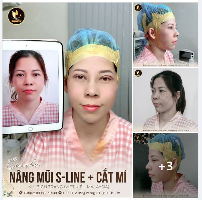 COMBO NÂNG MŨI S-LINE + CẮT MÍ