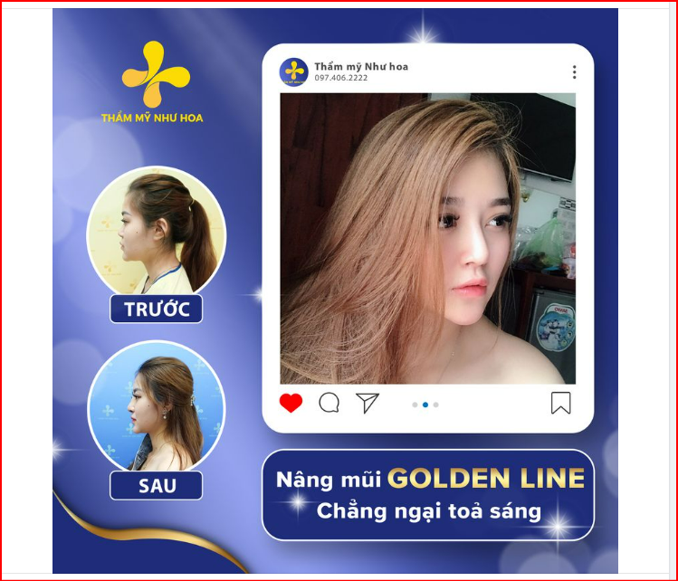 MŨI XINH - NHAN SẮC THÊM LUNG LINH chỉ sau HƠN 1 TUẦN! Thẩm mỹ Như Hoa cảm ơn sự tin tưởng và ủng hộ của chị Hồng Nhung!