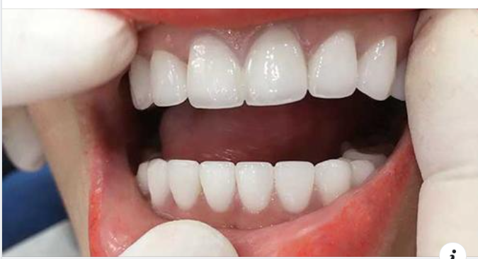 So Sánh Hàm Giả Tháo Lắp Và Trồng Răng Implant