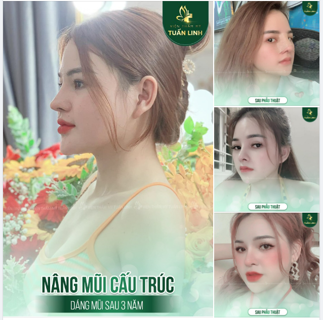 NÂNG MŨI CẤU TRÚC - DÁNG MŨI SAU 3 NĂM!!