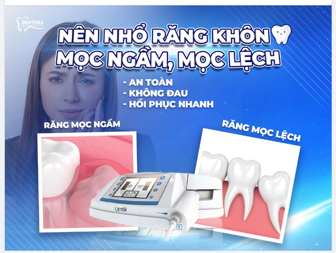 NÊN NHỔ RĂNG KHÔN MỌC NGẦM, MỌC LỆCH – AN TOÀN, KHÔNG ĐAU, HỒI PHỤC NHANH