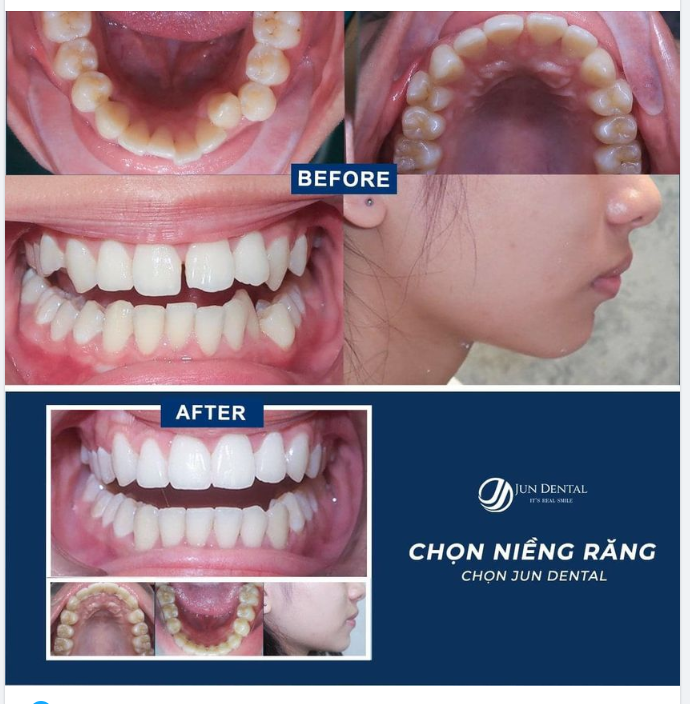 Ca lâm sàng niềng răng hô nhẹ và chen chúc; tháo mắc cài sau 20 tháng