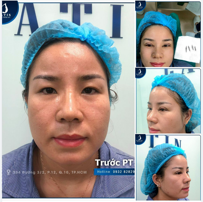 GIẢI CỨU MÍ SỤP - MẮT XINH RẠNG NGỜI