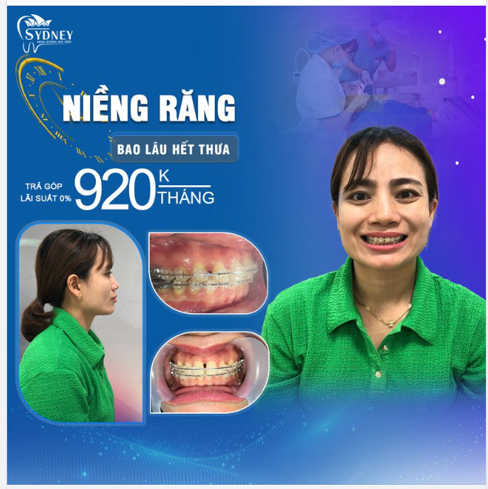 Niềng răng thưa mất bao lâu?