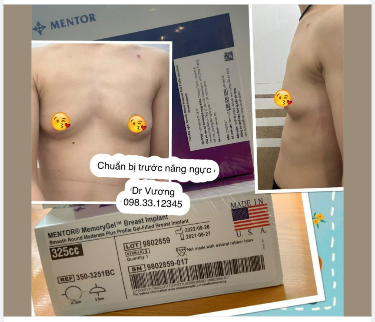 Những lưu ý trước các đại phẫu ở ngực như nâng ngực / treo ngực sa trễ / thu gọn ngực phì đại sa trễ với Dr Vương (kết phối hợp với tiểu phẫu thu quầng, thu núm)