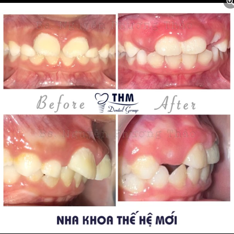 NIỀNG RĂNG SỚM CHO TRẺ BẰNG  KHI CỤ CƠ CHỨC NĂNG