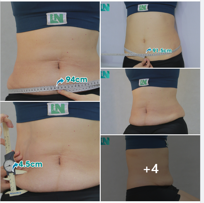 TÌM LẠI VÒNG EO SAU SINH CHO CHỊ KH (8X) ĐẾN TỪ ĐỒNG NAI. 