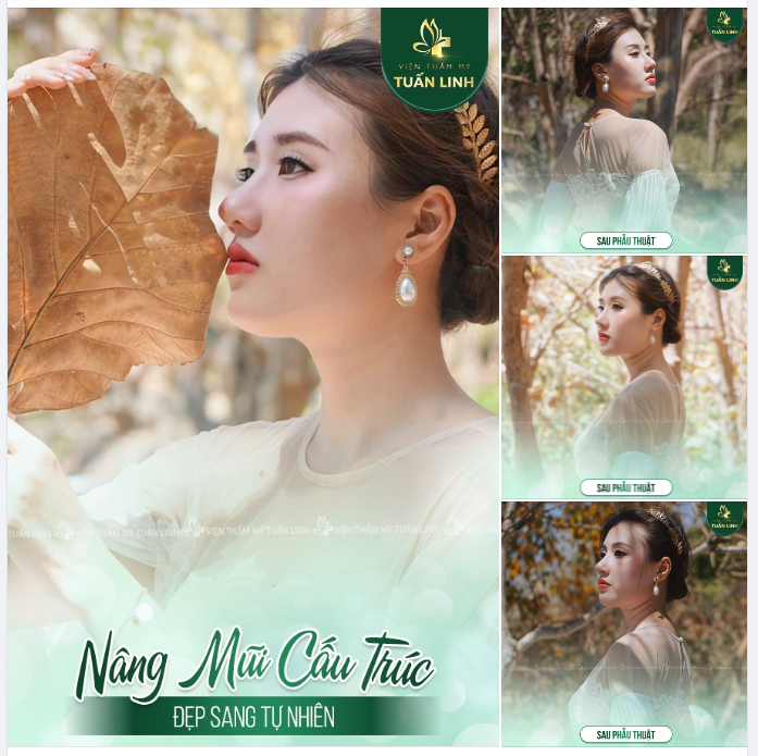 NÂNG MŨI CẤU TRÚC SURGIFORM - ĐẸP SANG TỰ NHIÊN