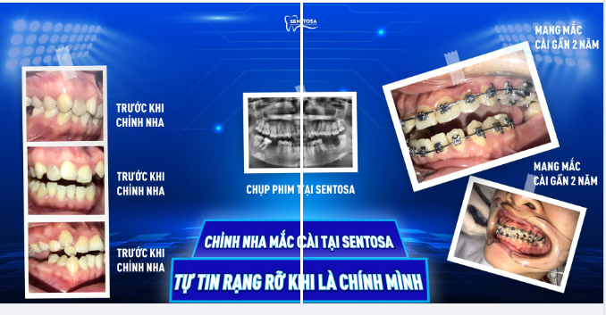 Vạn lý do để chọn Niềng răng mắc cài, nhưng có 1 sự lựa chọn đó là thay đổi để bản thân mình tự tin hơn trước