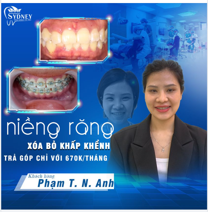 Khi nào phải nhổ răng khi niềng răng khấp khểnh?