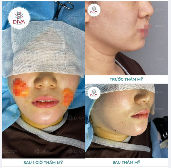 TÁCH MỠ MÁ - TIÊM MỠ CẰM: MẶT THANH THOÁT, CẰM VLNE