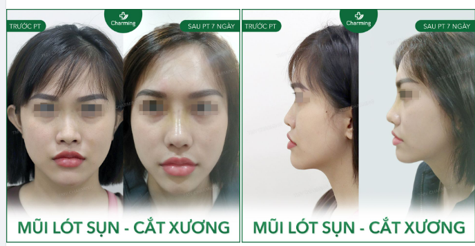 Nàng khách của Charming đã từng rất tự ti do dáng mũi thấp, sóng mũi không đủ độ nhô khiến tổng thể gương mặt nàng mất cân đối.