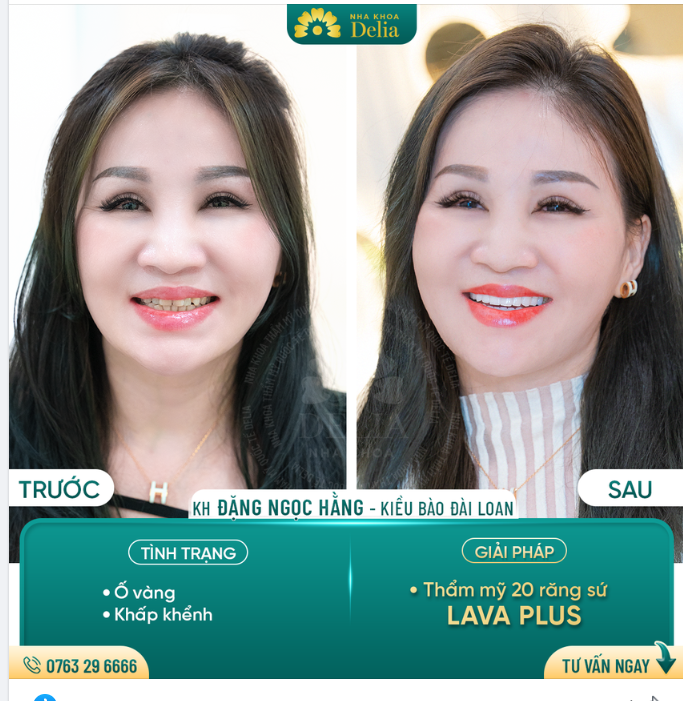 LỰA CHỌN HÀNG ĐẦU CỦA KIỀU BÀO THẨM MỸ RĂNG SỨ TẠI NHA KHOA DELIA
