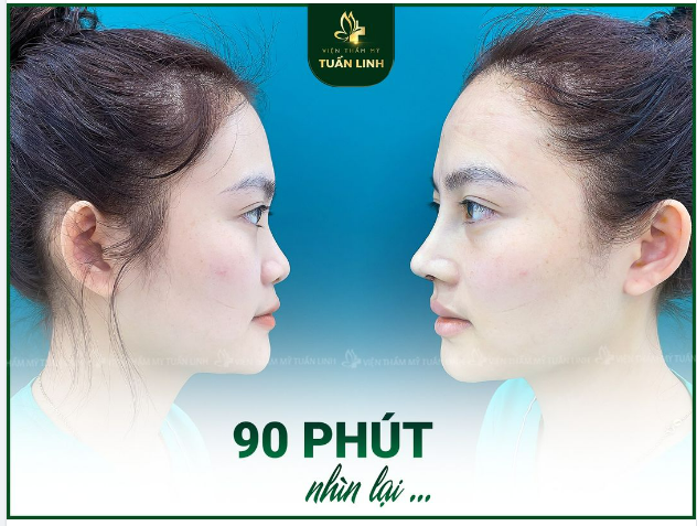 TIN ĐƯỢC KHÔNG: Sau 90 phút dáng mũi ''lột xác'' hoàn toàn - Đẹp xuất sắc.