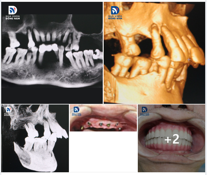 CASE THỰC TẾ 10 - XỬ LÝ TÌNH TRẠNG VIÊM NHA CHU NẶNG, CẤY IMPLANT PHỤC HÌNH 2 HÀM RĂNG VỮNG CHẮC