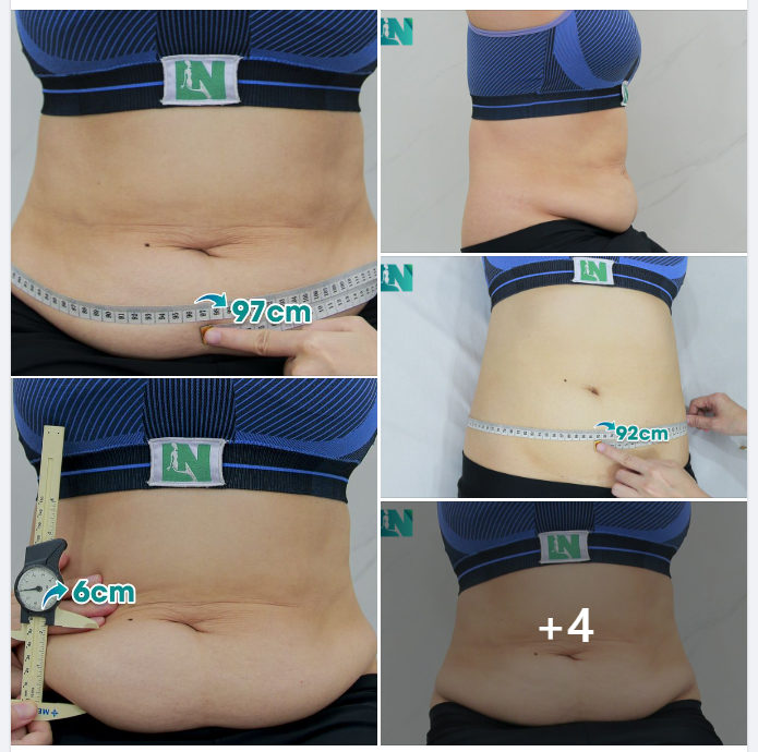  HÚT MỠ TẠO DÁNG THẨM MỸ KẾT HỢP  CẤY MỠ TẠO DÁNG V3