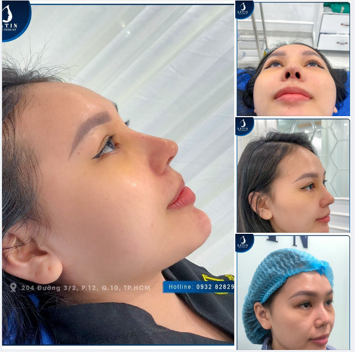 SỞ HỮU MŨI ĐẸP CHỈ SAU 7 NGÀY
