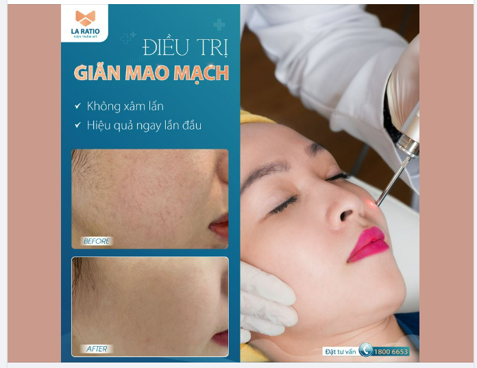 ĐIỀU TRỊ GIÃN MAO MẠCH TẬN GỐC - 100% Y KHOA