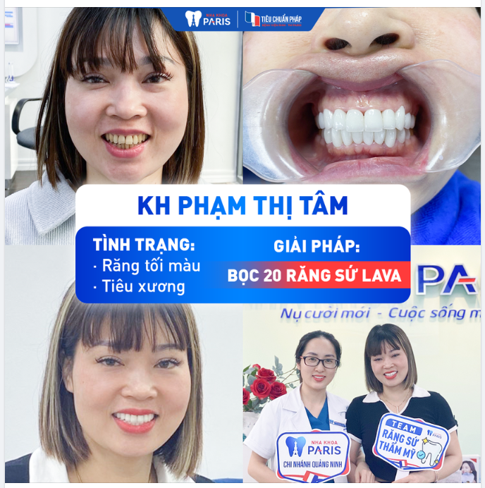 DỨT ĐIỂM TÌNH TRẠNG RĂNG TỐI MÀU, TIÊU XƯƠNG - KH PHẠM THỊ TÂM