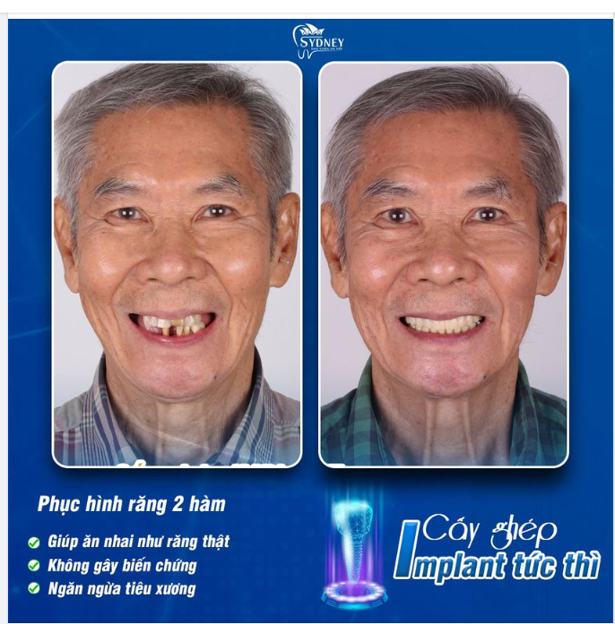 Điều kiện sức khỏe để cấy ghép Implant tức thì