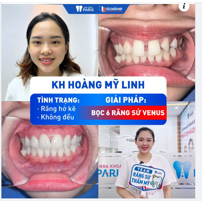BỌC 6 RĂNG SỨ VENUS CHO KH MỸ LINH - KHUYẾT ĐIỂM RĂNG THƯA HỞ KẼ VÀ KHÔNG ĐỀU