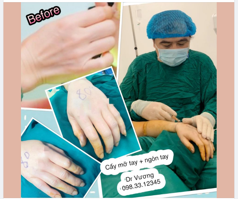 Cấy mỡ mu bàn tay  ngón tay với Dr Vương