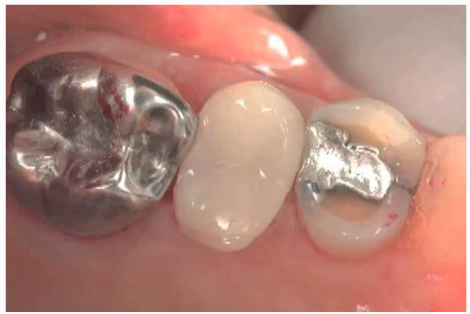 Những vật liệu trám răng thông dụng