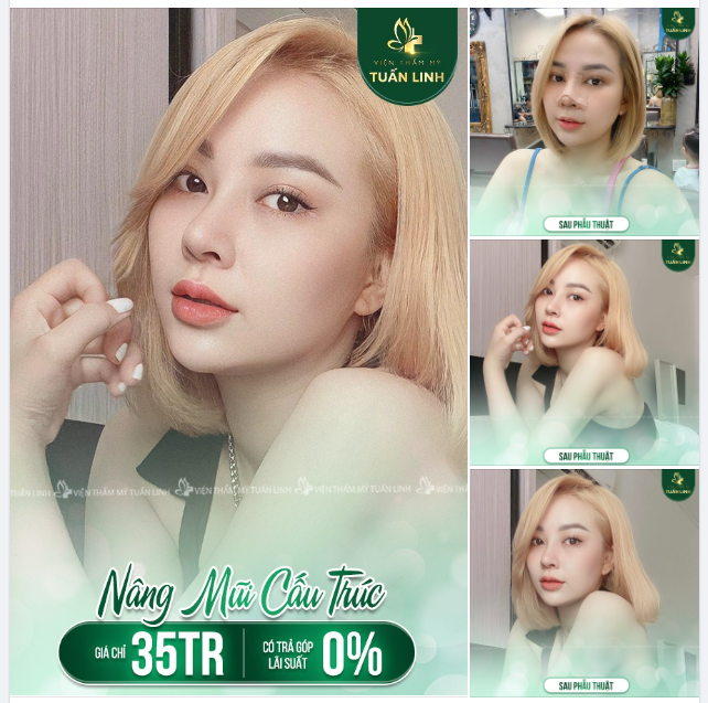 NÂNG MŨI CẤU TRÚC CHỈ 35TR - HỖ TRỢ TRẢ GÓP 0% LÃI