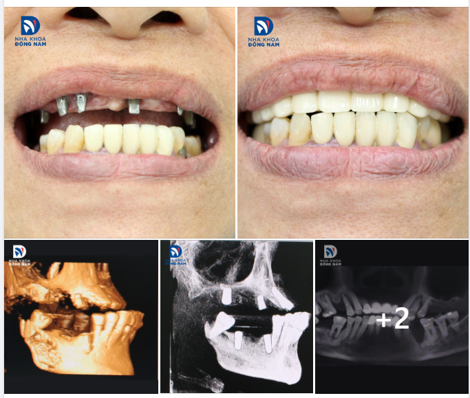 CASE THỰC TẾ 11 - RĂNG IMPLANT CHẮC KHỎE THAY THẾ TOÀN BỘ CÁC RĂNG LUNG LAY DO VIÊM NHA CHU