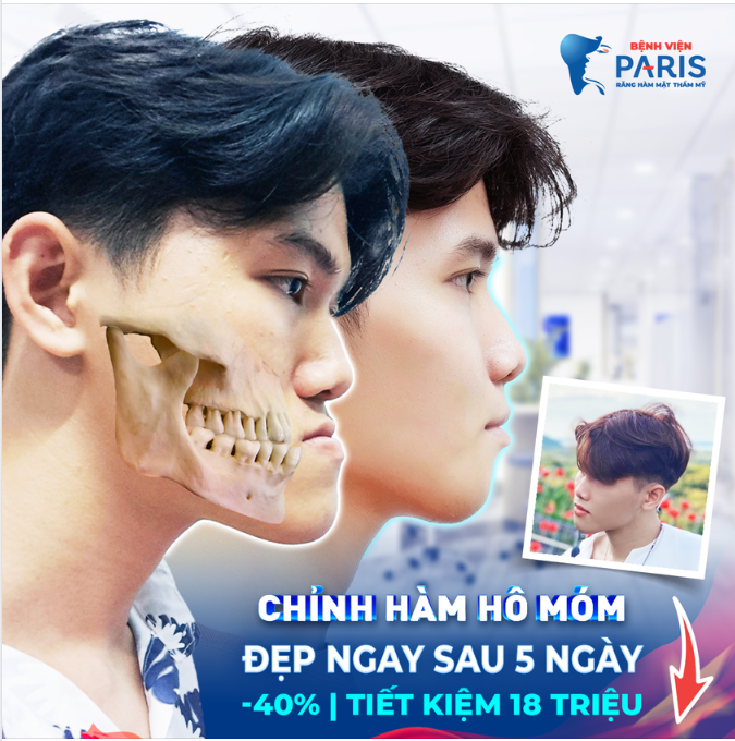 Đón Đại Lễ - Chỉnh hàm mặt CN xem trước kết quả - 5 ngày lành thương
