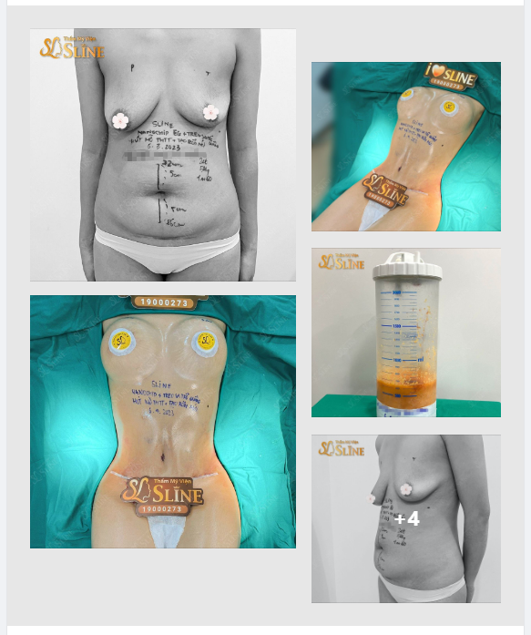 ĐIÊU KHẮC BODY. Với combo: Nâng cấp vòng 1(đặt túi Nanochip Eg). Hút mỡ tạo hình toàn thể tạo rốn mới