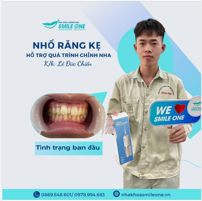 Răng kẹ hay còn gọi là răng thừa, mọc chen vào những chiếc răng vốn có sẵn trên cung hàm.