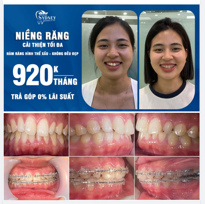 Niềng răng cải thiện tối đa hàm răng hình thể xấu – không đều đẹp