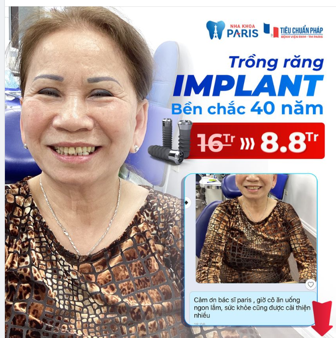 TRỒNG RĂNG IMPLANT CHUẨN BỆNH VIỆN