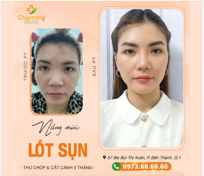 Trước nàng mũi tẹt, không cao. Sau nàng mũi gọn, mũi cao, hài hoà