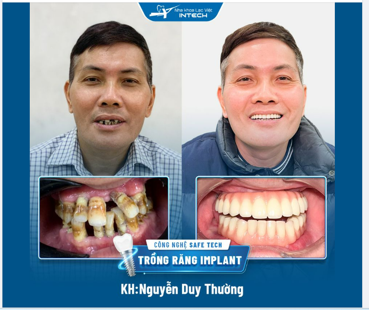 TRỒNG RĂNG IMPLANT – ĂN NHAI TỐT, THẨM MỸ ĐẸP