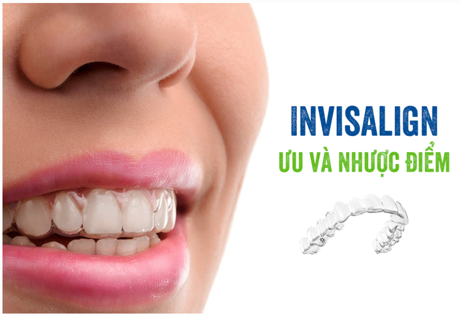 Niềng Răng Bằng Invisalign So Với Niềng Răng Truyền Thống