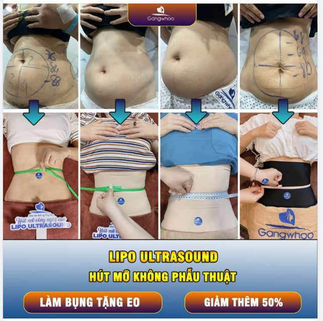 TẠI SAO LIPO ULTRASOUND LÀ KHẮC TINH MỠ THỪA?
