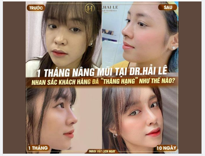 Dáng mũi 1 tháng tuổi của vị khách hàng đã thay đổi như thế nào so với trước đây?