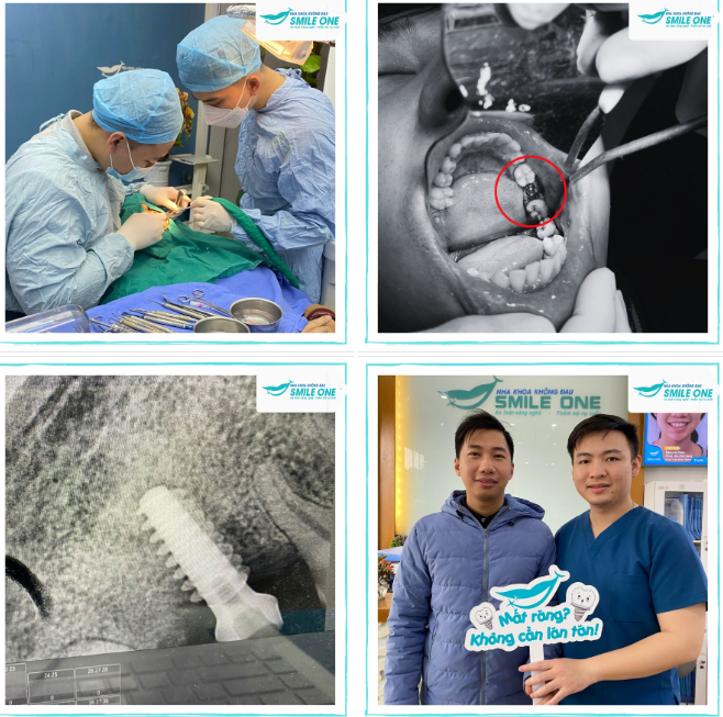 Trồng implant bệnh nhân Lê Thanh Tùng 32 tuổi.