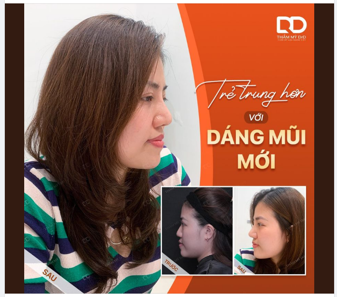 TRẺ TRUNG HƠN VỚI NÂNG MŨI PERFECT DFORM