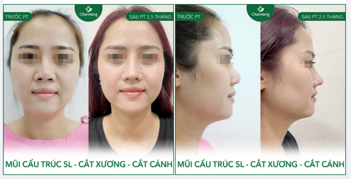 Nếu chỉ nhìn sơ qua thì ít ai có thể nhận ra chiếc mũi của nàng khách đây đã từng “qua một chuyến đò” và phải tìm đến Charming để sửa lại bằng phương pháp nâng mũi cấu trúc.