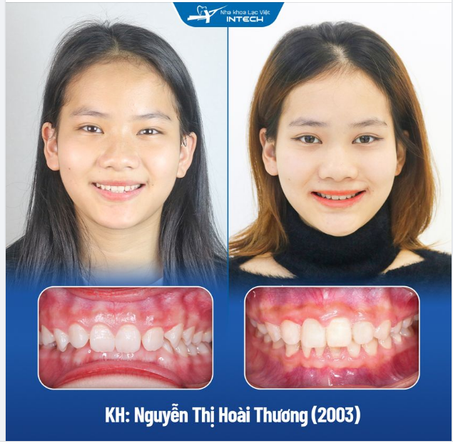 TẠM BIỆT KHỚP CẮN SÂU NHỜ NIỀNG RĂNG CÔNG NGHỆ X-MATRIX TẠI LẠC VIỆT INTECH